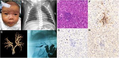 Case Report: Novel JAG1 gene mutations in two infants with alagille syndrome characterized by cholestasis